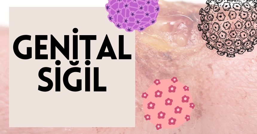 Genital Siğil